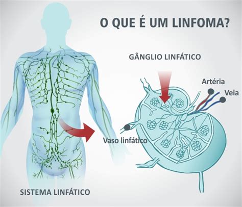 o que e linfoma